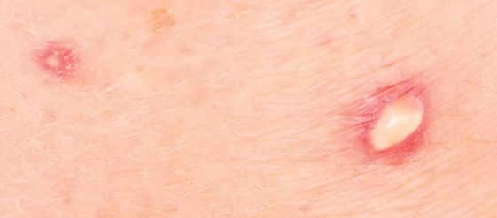 Ant Bite & Sting Facts