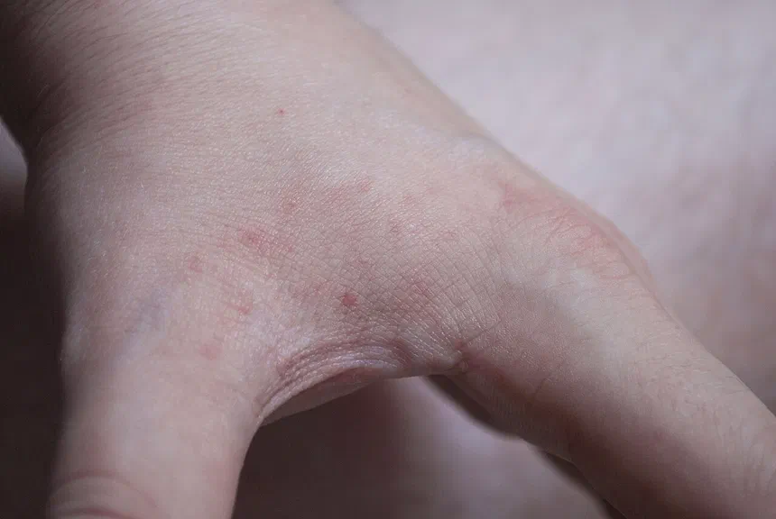 Bed Bug Bite Symptoms
