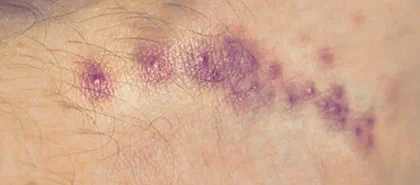Scabies Rash