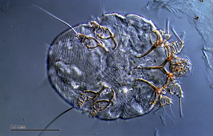 Scabies Rash