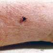 Tick Bites