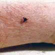 Tick Bites